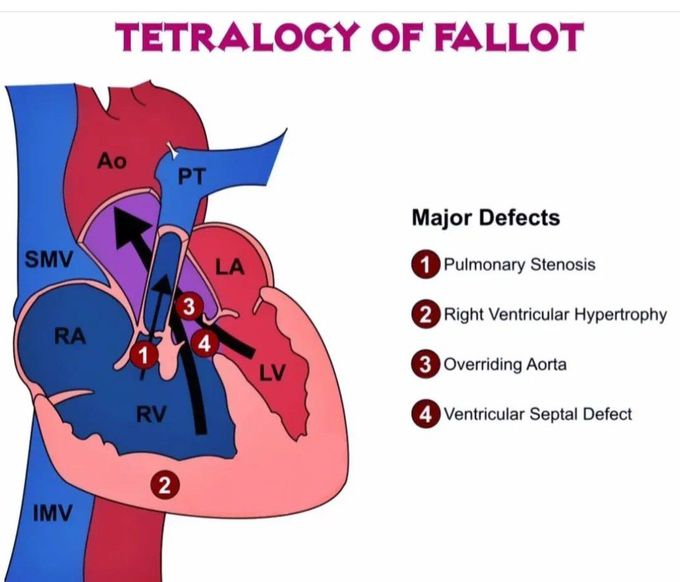Teratology of Fallot