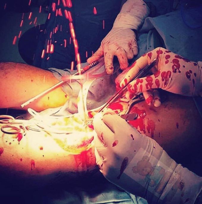 Arterial rupture