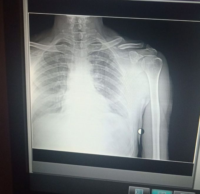Left side clavicular bone