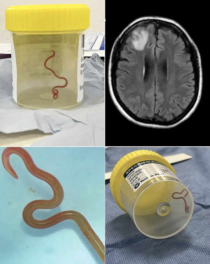 Neurosurgeon removes live 8cm long worm from woman's brain!!