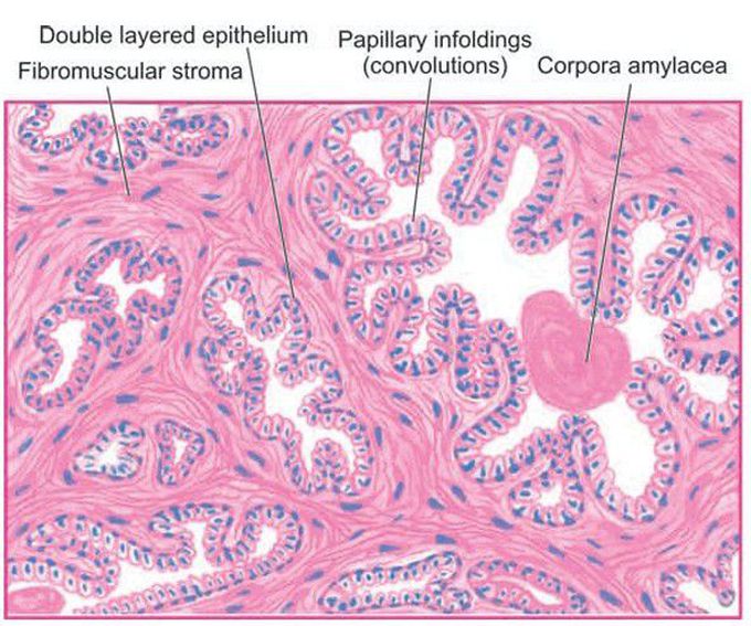 Nodular hyperplasia of the prostate.