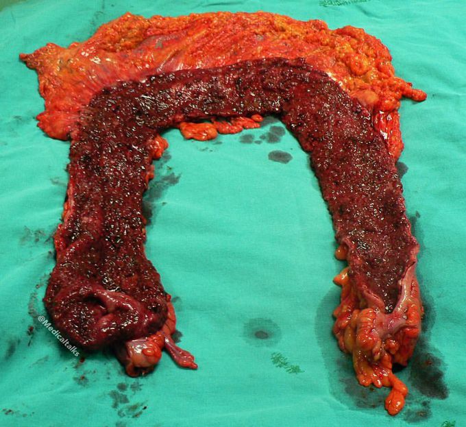  Extensive ulcerative colitis