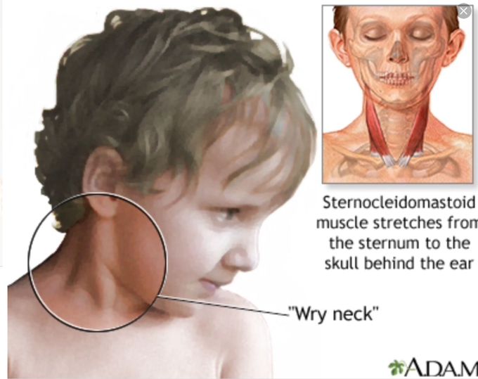 Congenital muscular Torticollis