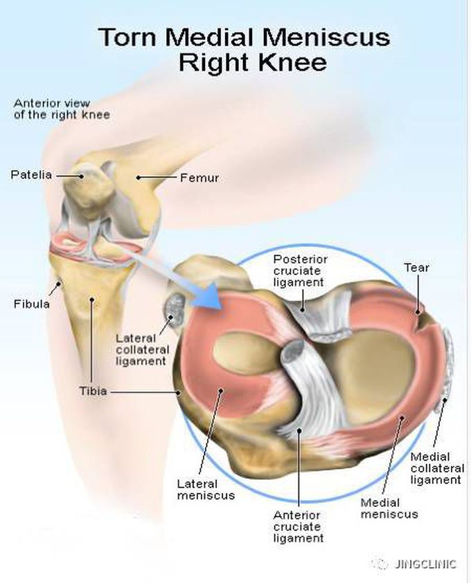 torn meniscus