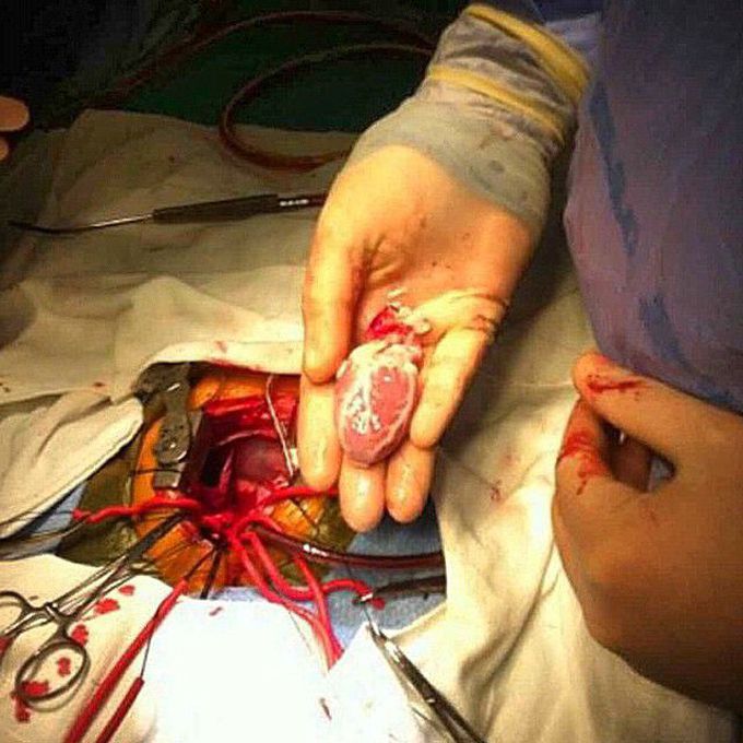 Pediatric heart transplant