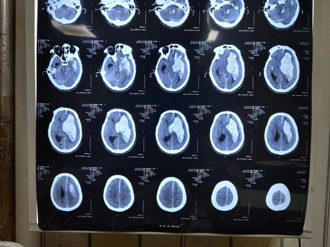 Massive hemorrhagic CVA