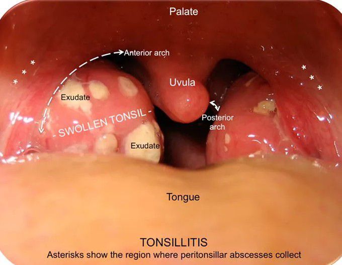 Tonsillitis