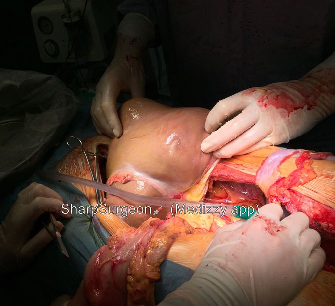 Harvesting Liver for Transplant 🔁