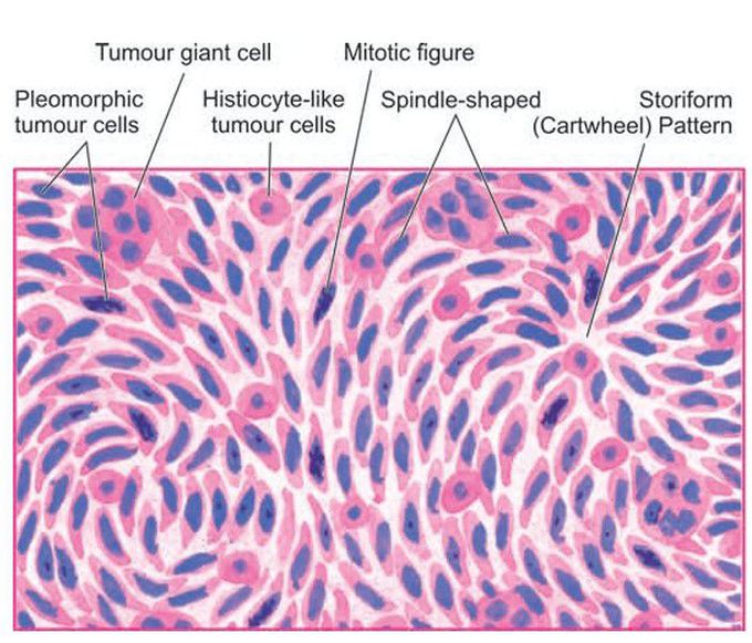 Malignant fibrous histiocytoma