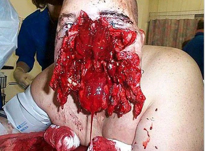 Shotgun injury
