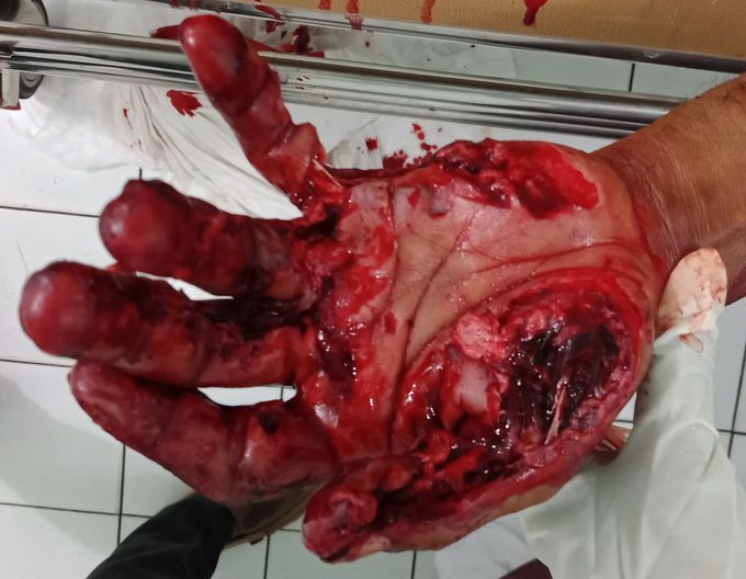 CHAINSAW injury