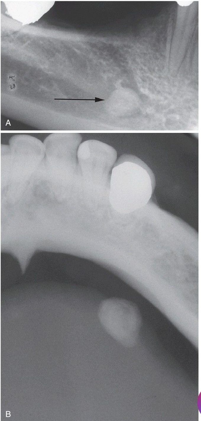 Sialolithiasis