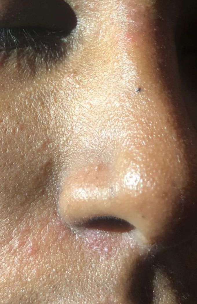Reddish apperences in face. please diagnose