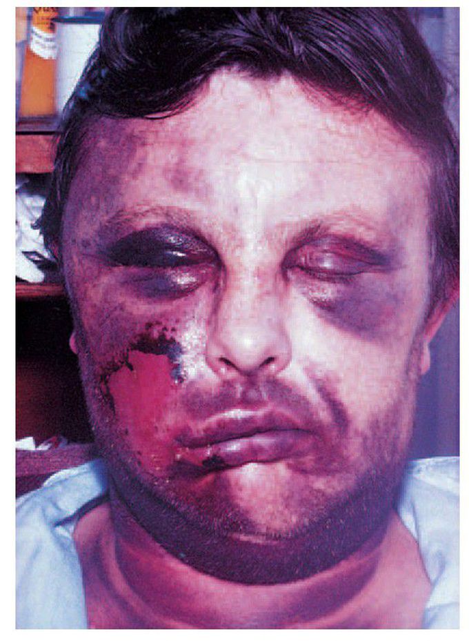 Haemophilia
