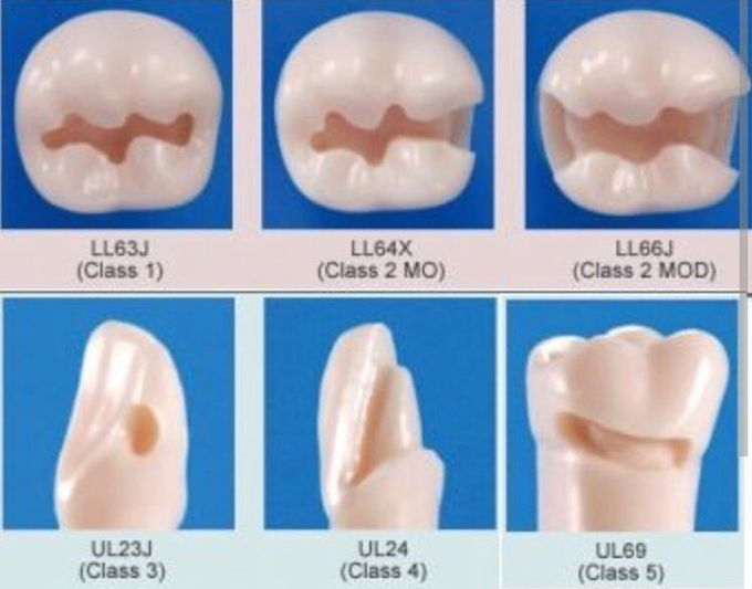 Cavity preparation in conservative dentistry