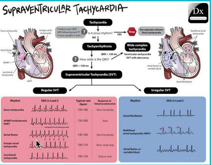 Supraventricular Tachycardia