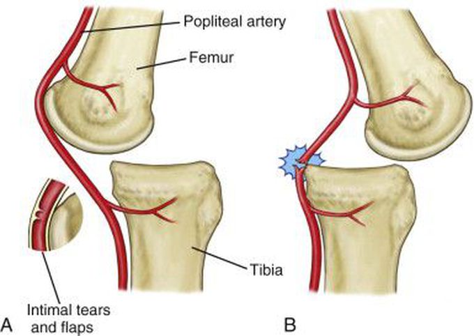 Arterial Injury Associated with Knee Dislocation