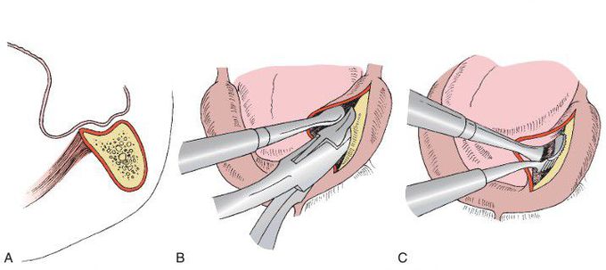 Mylohyoid ridge reduction.