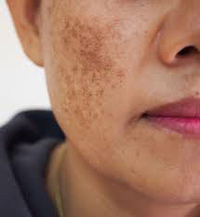 Melasma