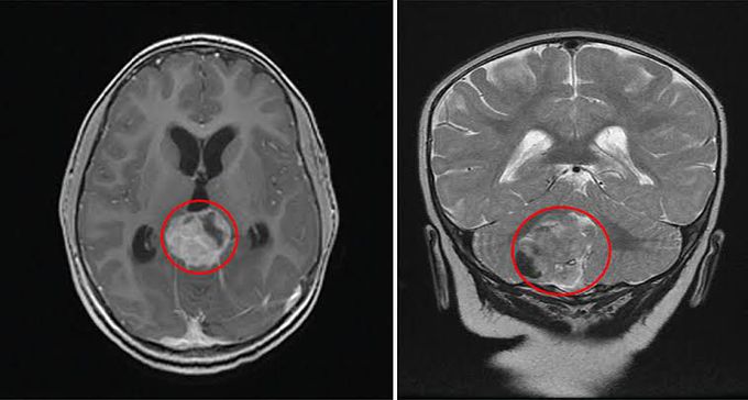 Symptoms of rhabdoid tumors