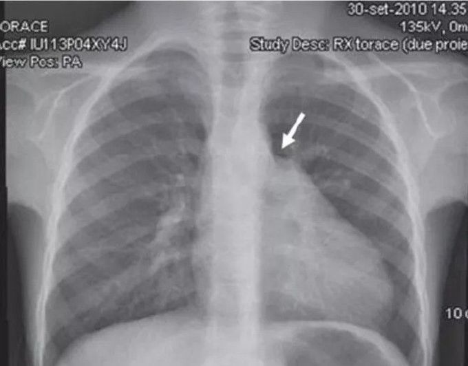 cardiovascular surgery