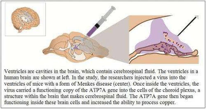 Menkes disease treatment