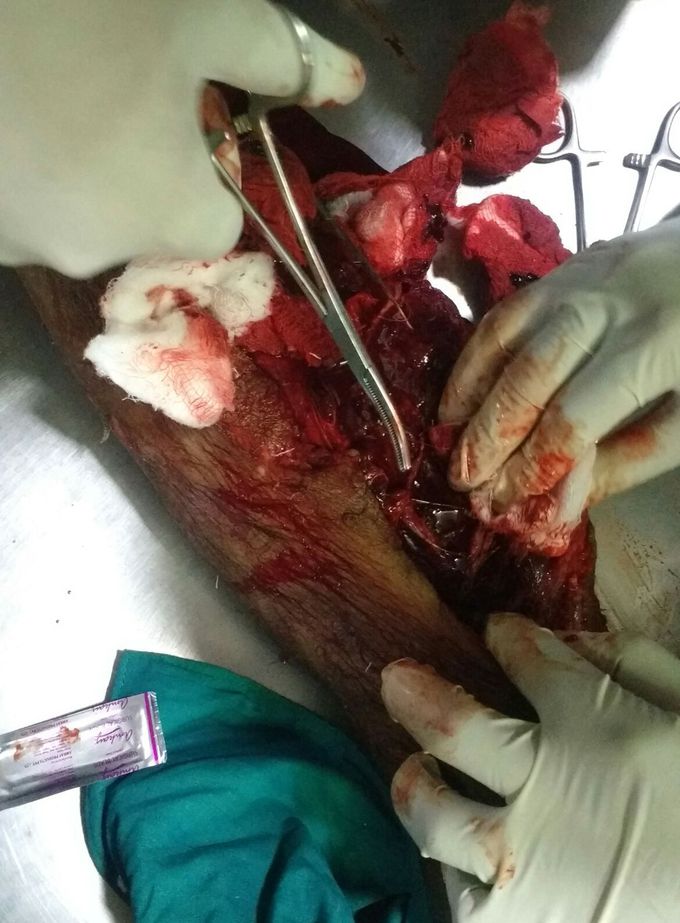 Tibia fracture