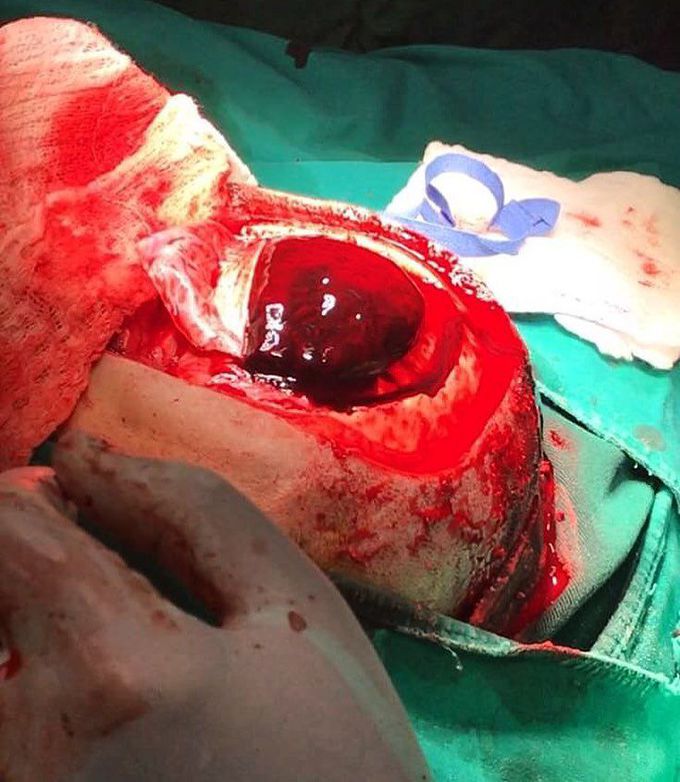 Craniotomy