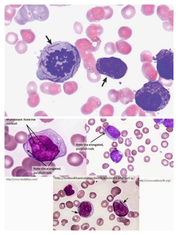 Auer rods seen in myeloblastic leukemia. Presence of Auer rods differentiate myeloblastic leukemia from lymphoblastic leukemia.