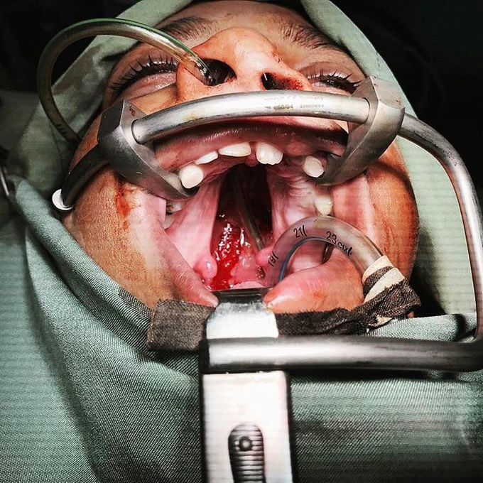 A 10-year-old boy gets a surgery to repair his cleft palate!