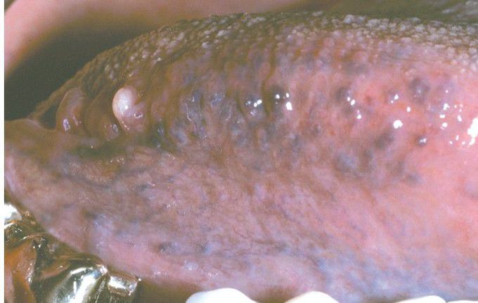 Oral lymphoepithelial cyst