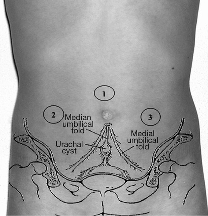 Laparoscopic management of urachal cysts