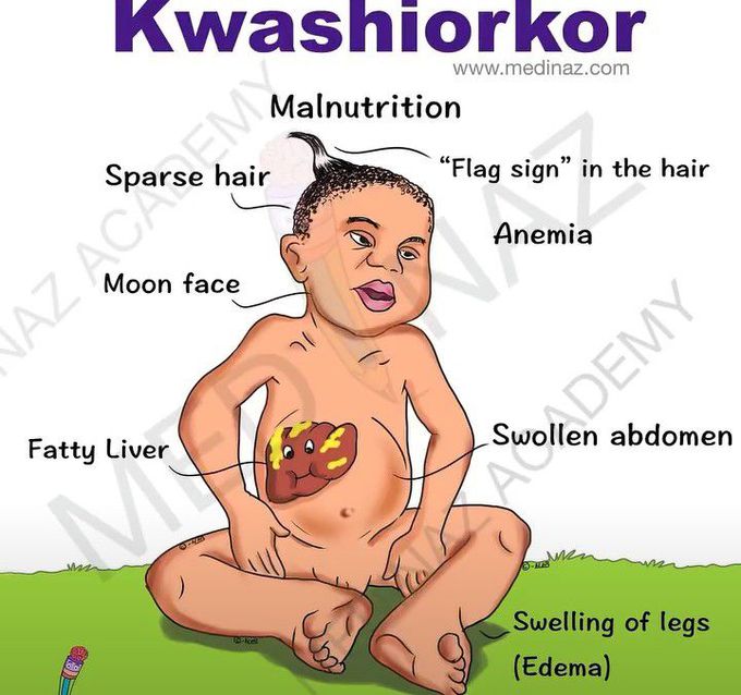 Kwashiorkor-Visual Mnemonic
