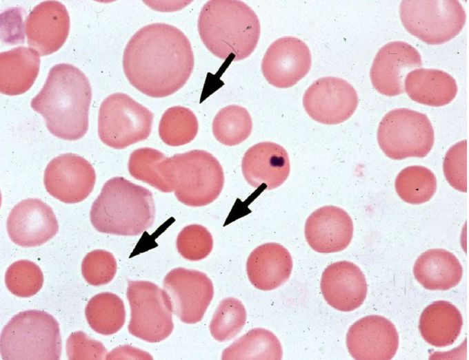 Hereditary Spherocytosis (HS)