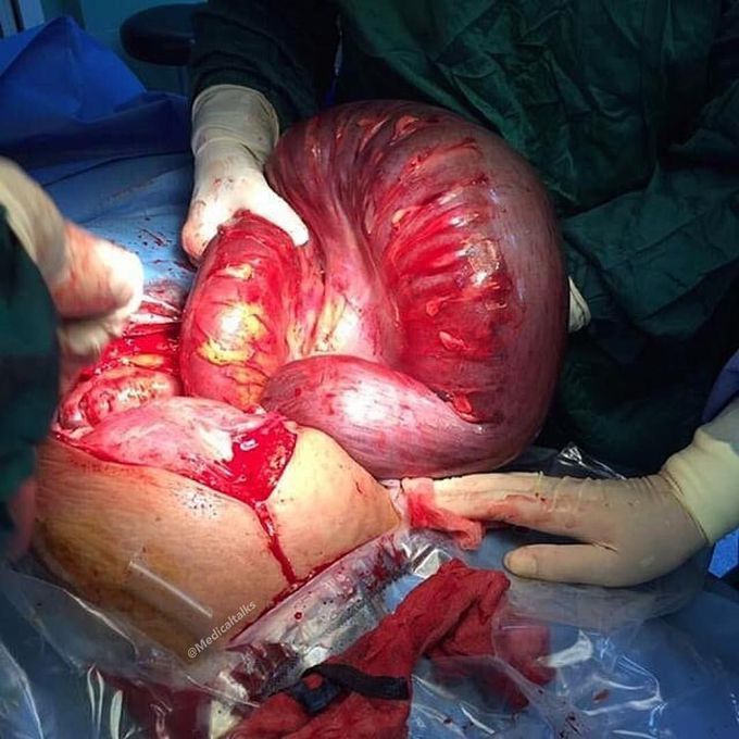 Operation for an intestinal obstruction due to volvulus in a 32 weeks pregnant lady!! 