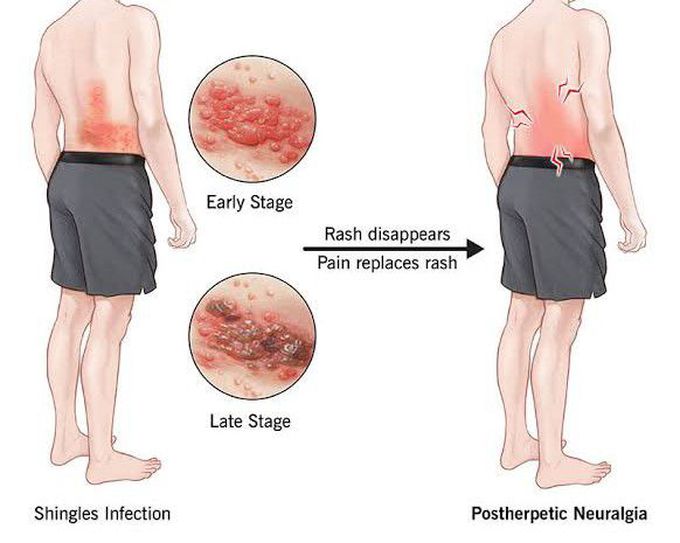 Post herpetic neuralgia causes