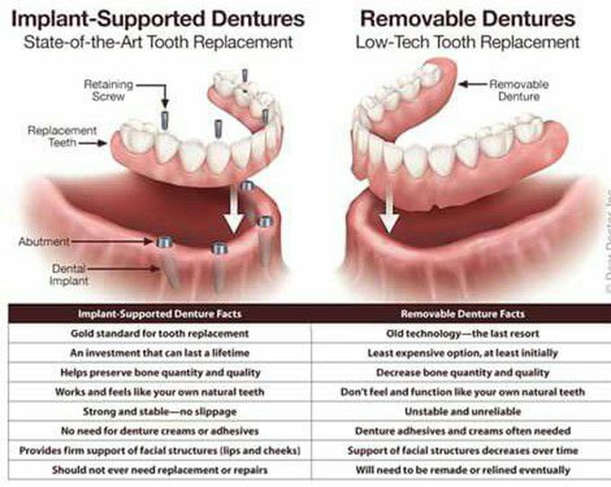 Diff. Of RPD and Implants.important to kno