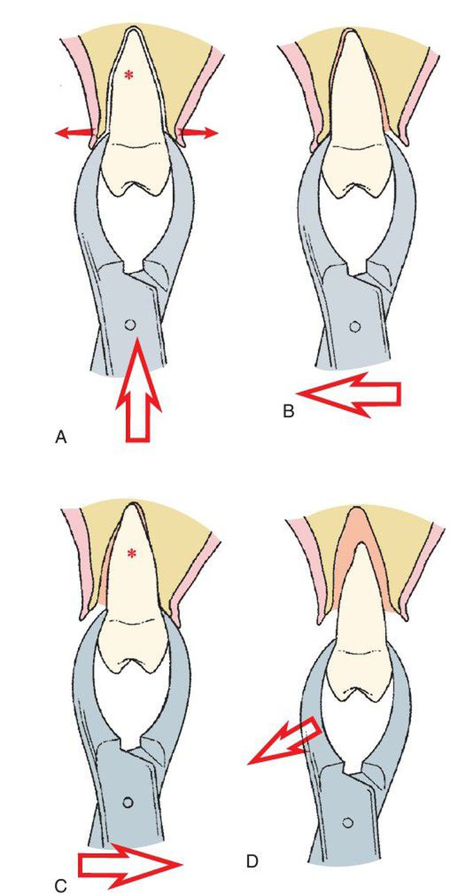 Maxillary 2nd premolar extradition