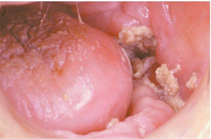 Osteoradionecrosis (ORN).