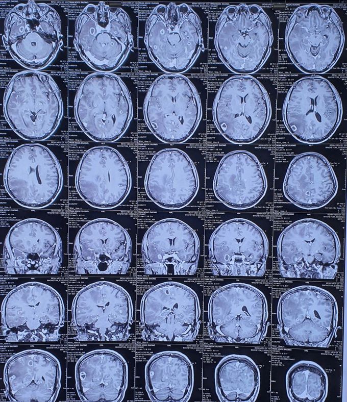 What is the diagnosis?