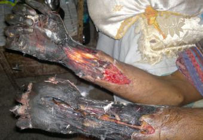 Complications of Electric Burns