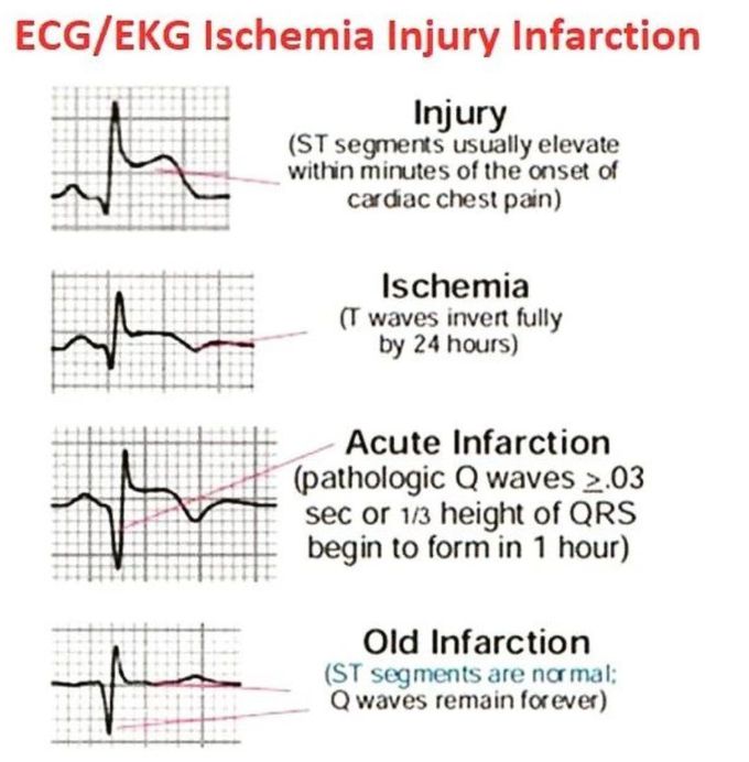 ECG- Ischemic Injury