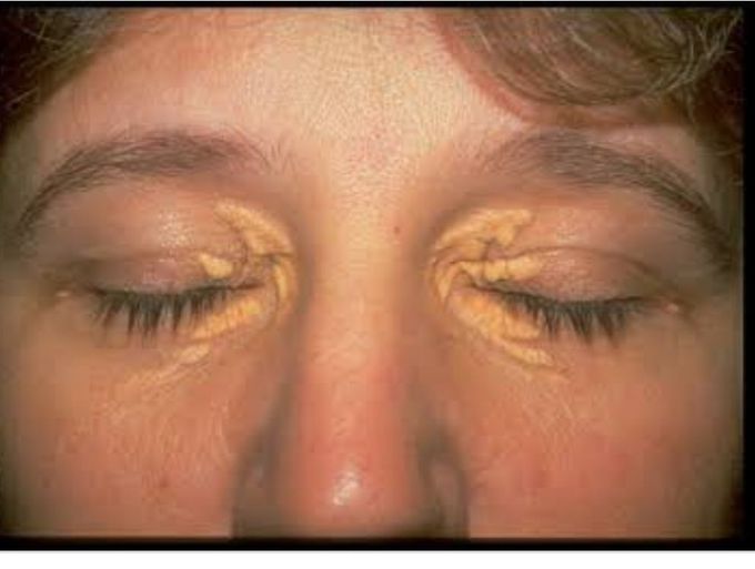 Xanthelasma due toh dyslipidimea
