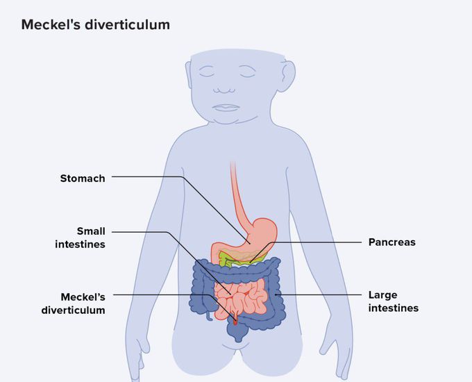 Cause of Meckel's diverticulum