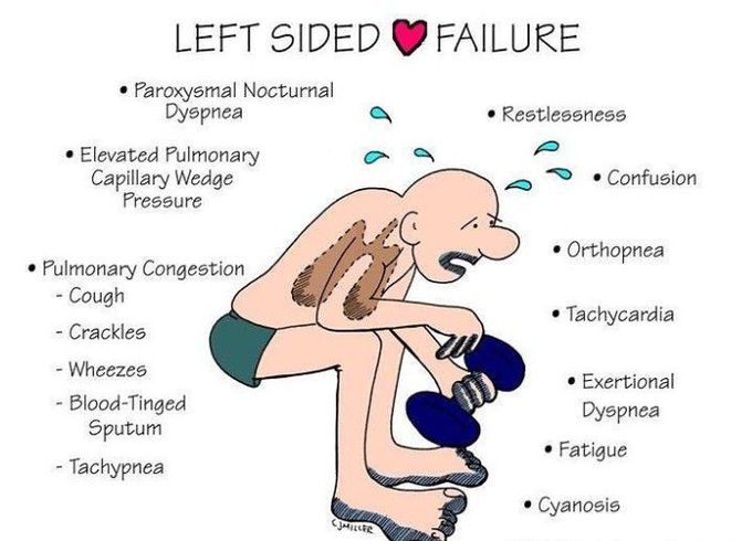 Left sided heart failure