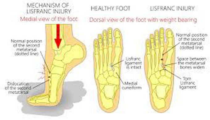 Causes of lisfranc injury