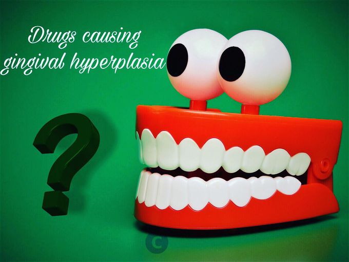 Gingival hyperplasia caused by drugs