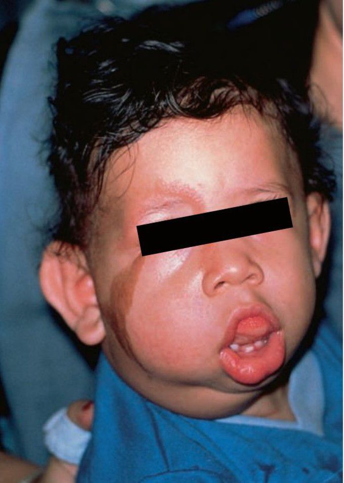 Epidermal nevus syndrome