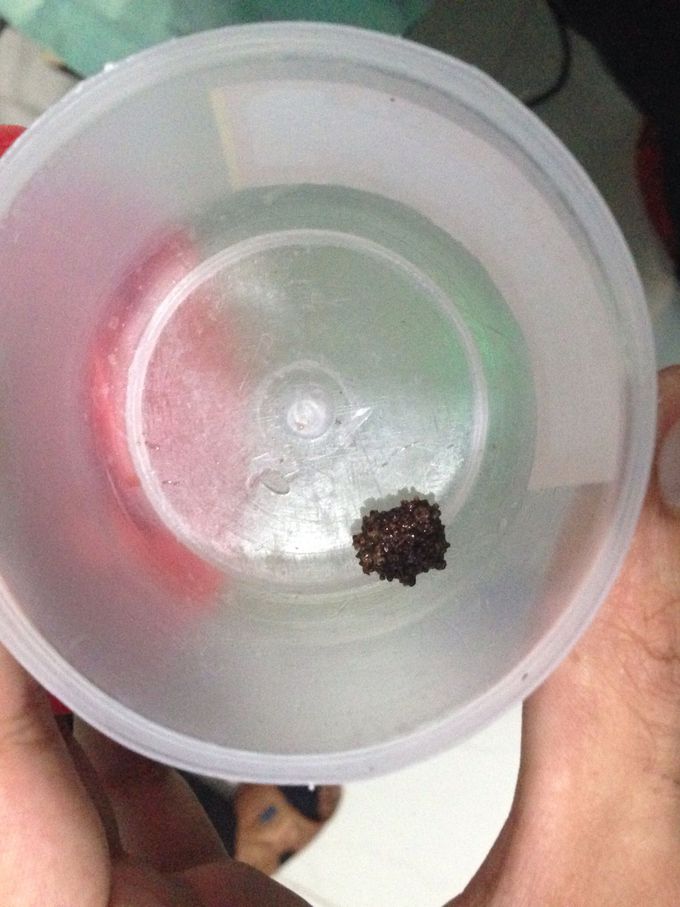 Bladder Stone