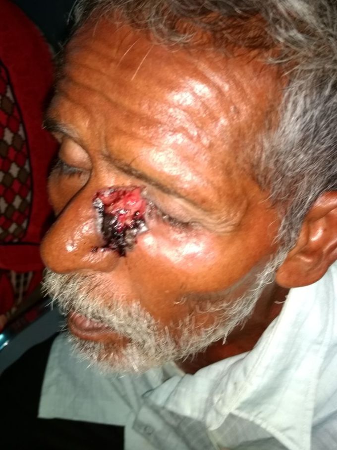 Basal cell carcinoma